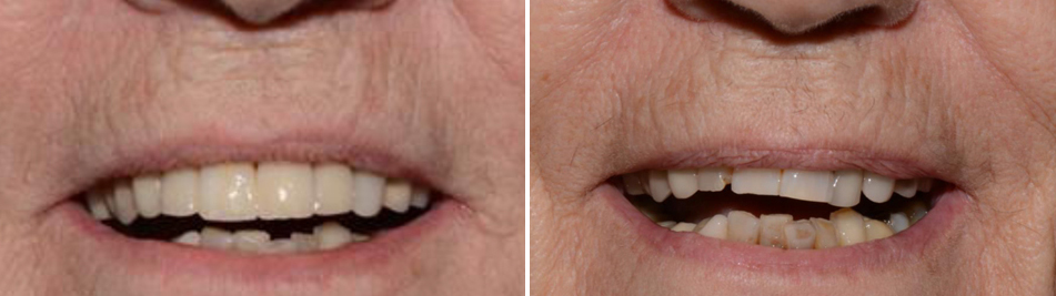 כתרי EMAX לשיניים קדמיות