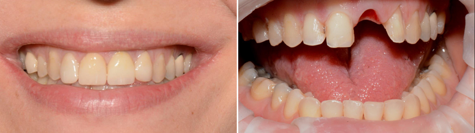 עקירת שורש והתקנת שתל מיידי